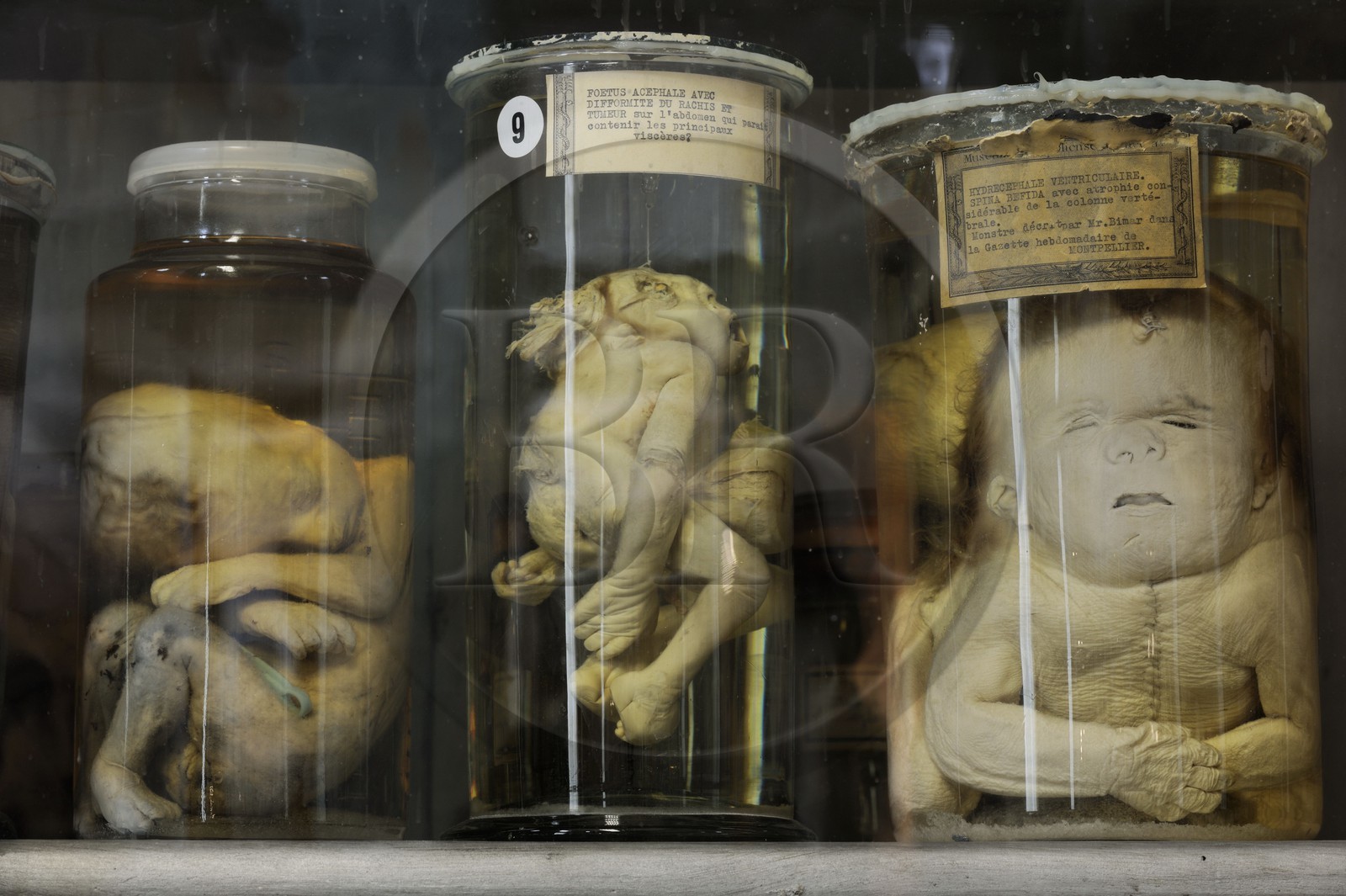 France, Hérault (34), Montpellier, centre historique, faculté de médecine, le musée d'anatomie, foetus de la collection de tératologie qui est l'étude scientifique des malformations congénitales