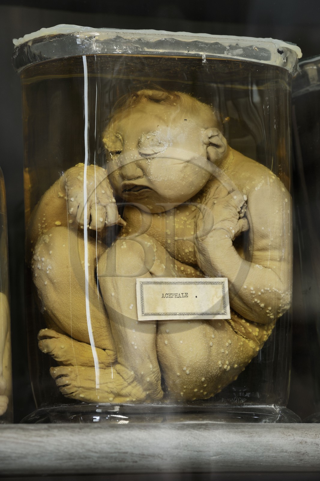 France, Hérault (34), Montpellier, centre historique, faculté de médecine, le musée d'anatomie, foetus de la collection de tératologie qui est l'étude scientifique des malformations congénitales